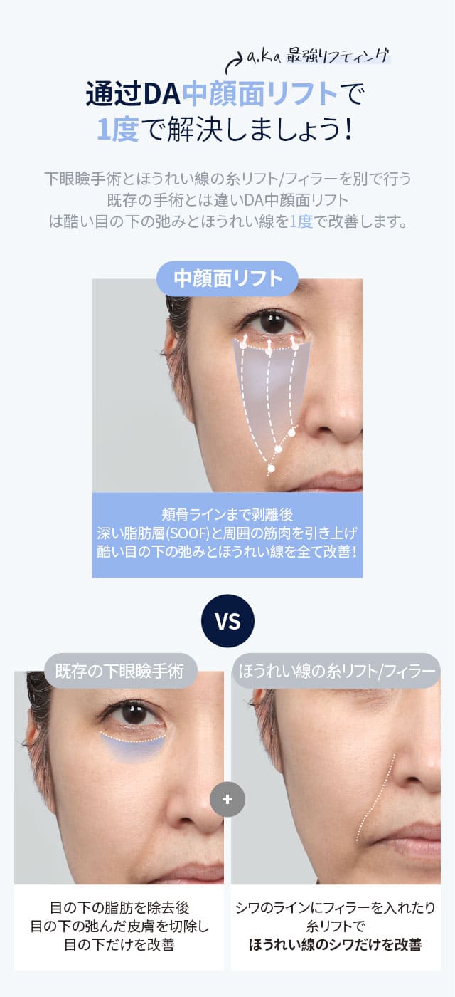 DA中顔面リフト