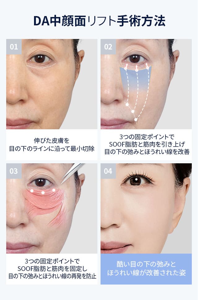 DA中顔面リフト