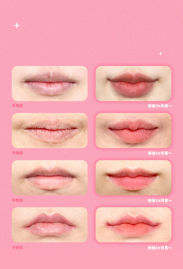 DA口角挙上手術