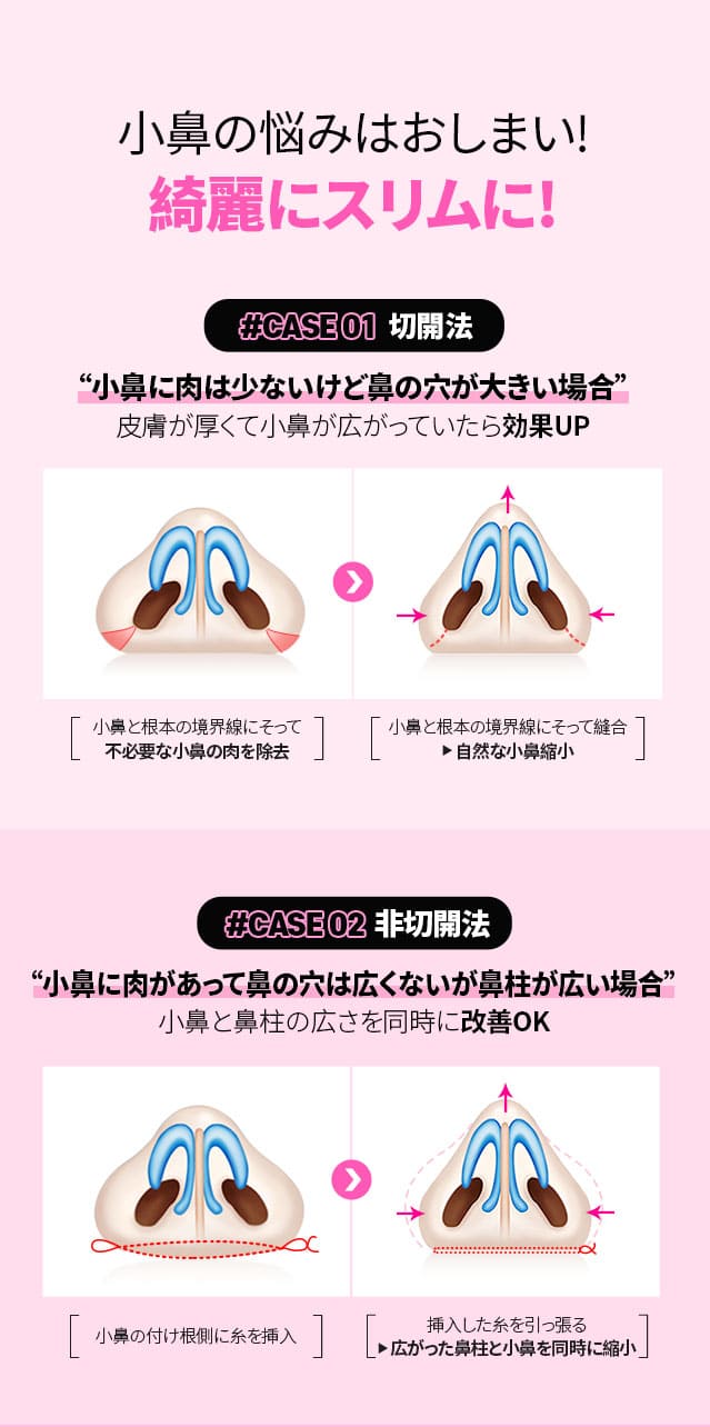 小鼻の悩みはおしまい!綺麗にスリムに!