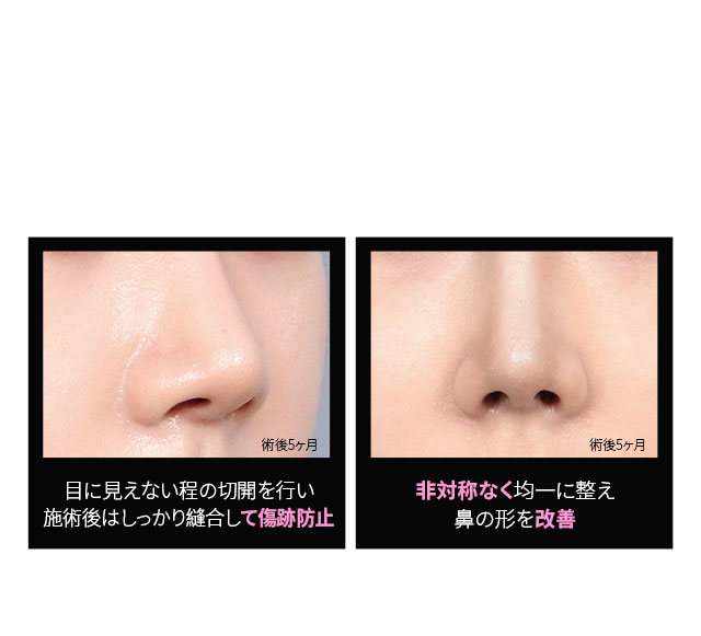 小鼻縮小