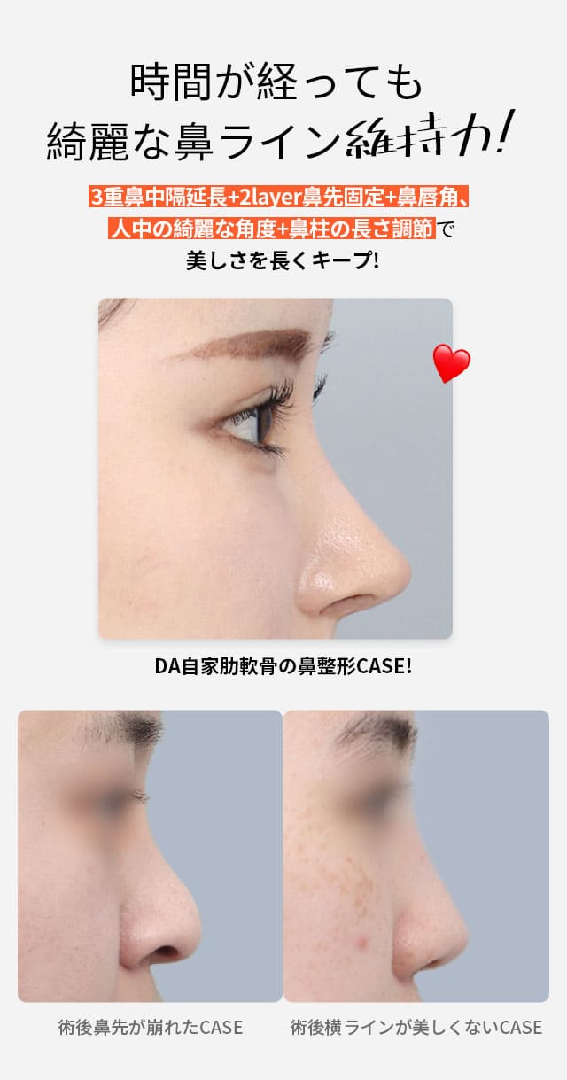 自家肋軟骨鼻整形