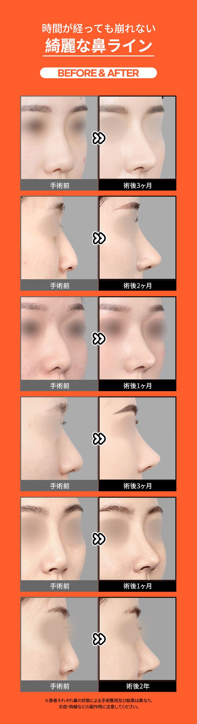 自家肋軟骨鼻整形