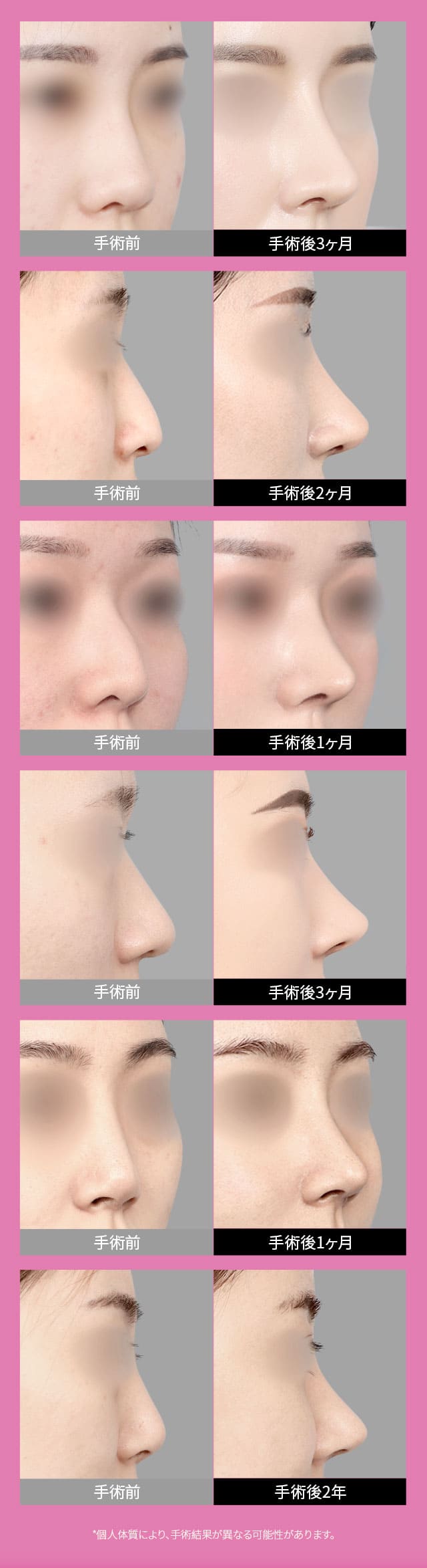 手術前&手術後
